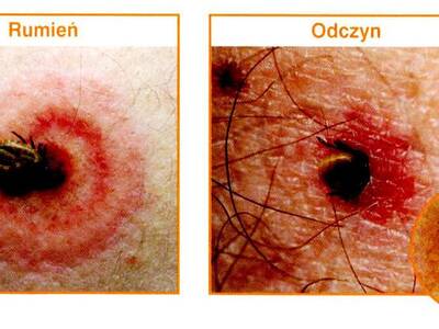 Obraz 4: Borelioza - najczęstszą chorobą wśród rol...